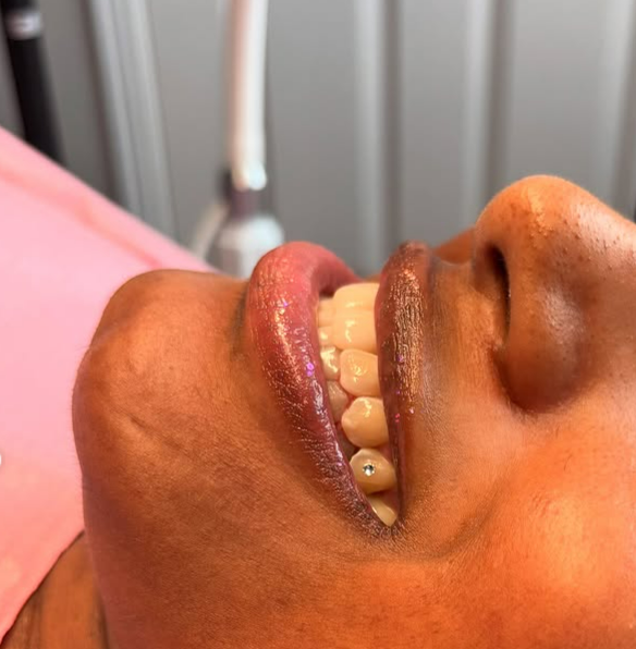 Cosmetic Teeth Whitening